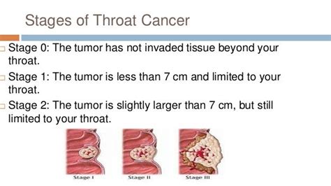 stage 4 throat cancer prognosis.